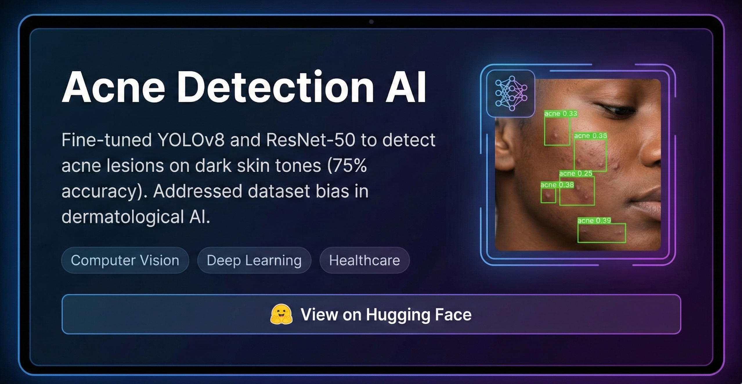 Acne Detection AI